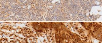numérisation d’un marquage ADAR1 sur deux échantillons de cancer du sein triple-négatif 