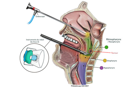 opération du rhinopharynx