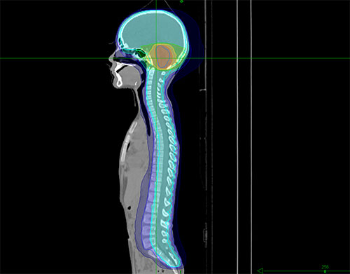 contourage de medullo cranio spinal 