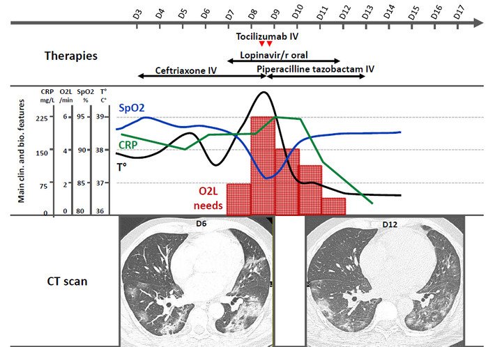 Tocilizumab