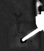 Angio-mammographie après prélèvement de biopsie 