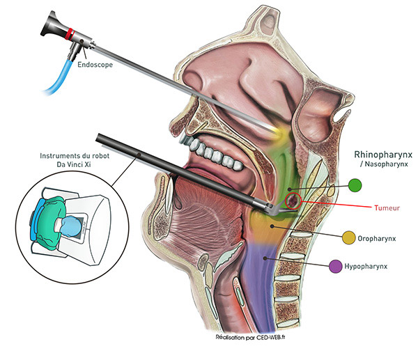 Chirurgie ORL assistée par robot