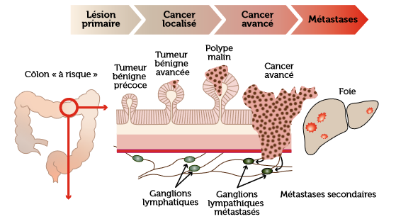 Graphique - transformation d'un polype en cancer colorectal