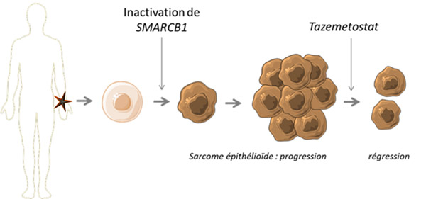 les sarcomes épithélioïdes