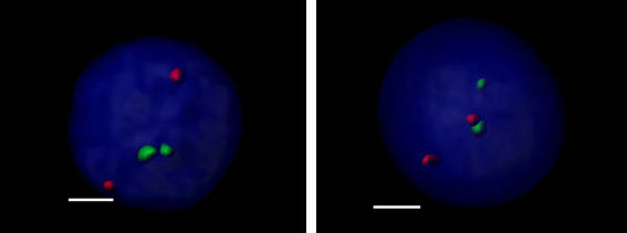 Localization of the MYC (red) et IGH (green) loci